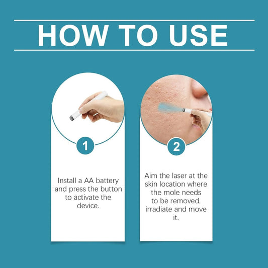 Xorita Non-Invasive Mole & Wart Removal Laser Pen